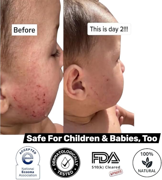 Loma Lux New Eczemol OTC Spray Natural & No Sting Hypochlorous for Eczema, Wounds, Burns, Cuts, Skin Irritation, Radiation Dermatitis, Sunburn, Itchy Skin, for Kids & Adults