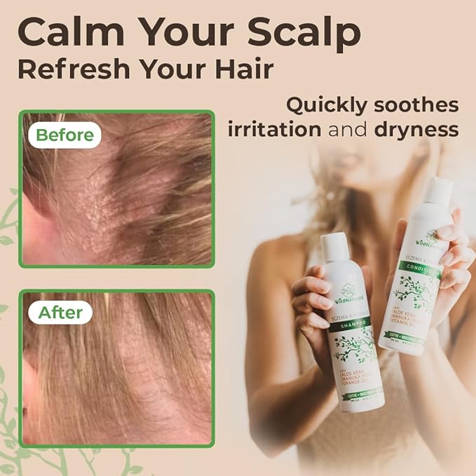 Eczema and Psoriasis Deep Conditioning Treatment - Anti-Dandruff Conditioner for Damaged, Dry Hair and Scalp - Seborrheic Dermatitis Relief