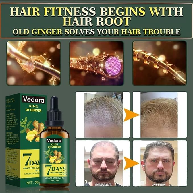 Vedora Ginger Oil for Hair Growth alongwith Roller - Hair Growth Serum, 100% Pure Natural Ginger Essential Oil - Promotes Strong, Thick, Long Hair in Women & Men - 5.05 Fl Oz / 150ML (5 PCS+Roller)