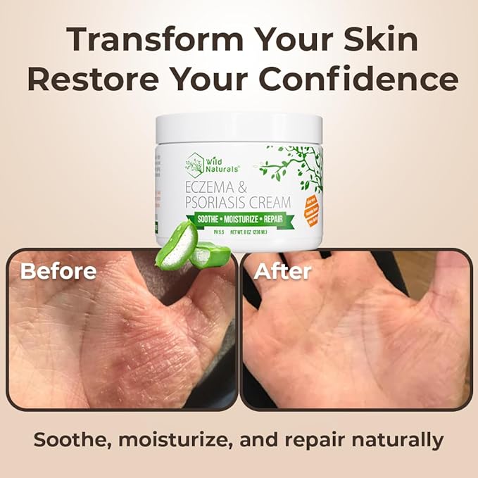 Wild Naturals Eczema & Psoriasis Cream for Dry, Itchy Skin – Eczema Relief for Adults & Kids – Moisturizing Psoriasis Cream with Manuka Honey