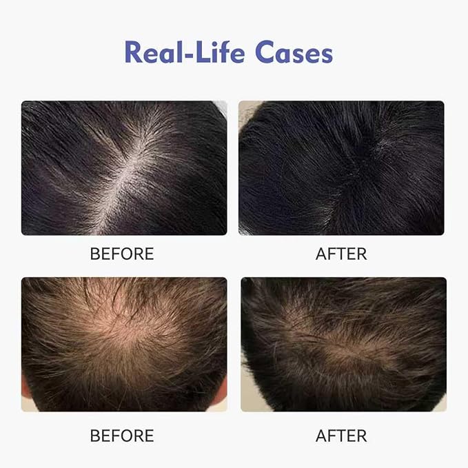 0.9% KX-826 KINTOR Hair Growth Products Foam, DHT Blocker for Men & Women Hair Regrowth, 360ml Pro
