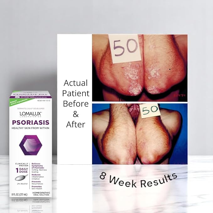 Loma Lux Psoriasis Relief Natural w/Minerals - Multi-Symptom Relief - Clinically Proven Treatment Dermatologist Developed for Psoriasis Vulgaris, Seborrheic Dermatitis, Scalp, Inverse Types - 8 Fl Oz