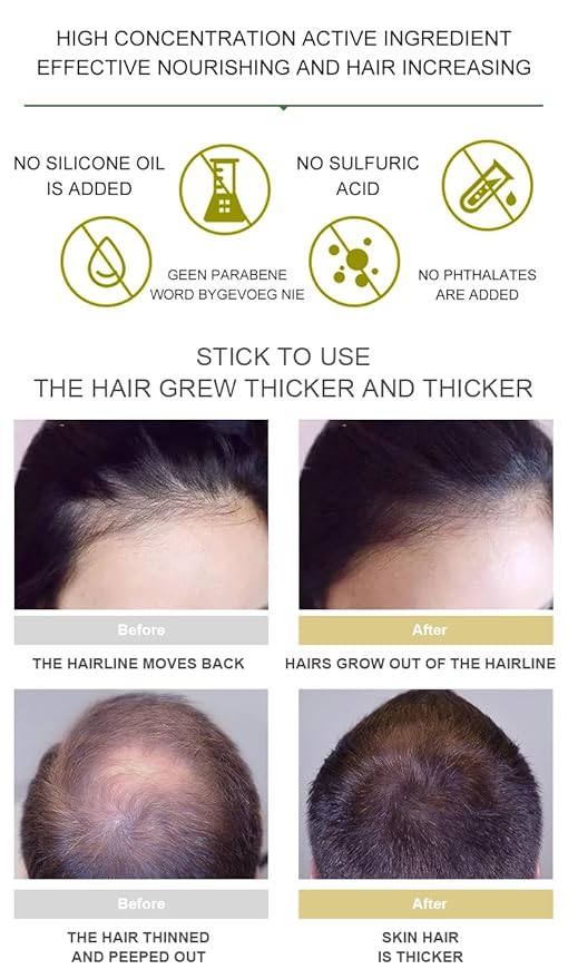 Vedora Ginger Oil for Hair Growth alongwith Roller - Hair Growth Serum, 100% Pure Natural Ginger Essential Oil - Promotes Strong, Thick, Long Hair in Women & Men - 5.05 Fl Oz / 150ML (5 PCS+Roller)