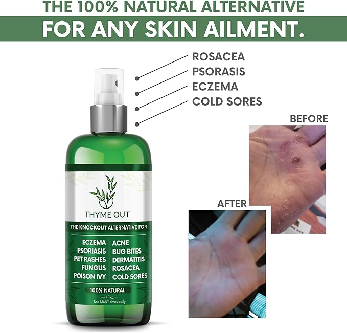 All Natural Eczema Treatment- Psoriasis Treatment - an All-in-One Solution for Acne, Dermatitis, Rosacea, Cold Sores, Bites, Poison Ivy - Anti-Itch Spray for Itchy Skin Relief 4oz