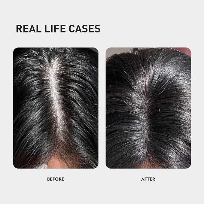 0.9% KX-826 KINTOR Hair Growth Products Foam, DHT Blocker for Men & Women Hair Regrowth, 240ml Pro