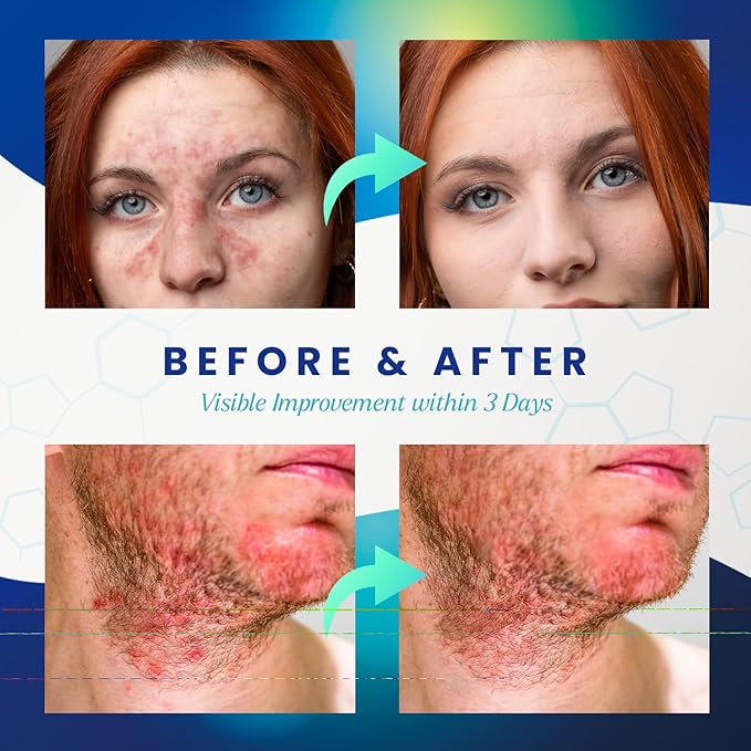 Seborrheic Dermatitis Psoriasis Cream: Antifungal Treatment - Traditional Herbal Infused - Relief for Flaking Irritated Scalp Skin - Steroids Free Lasting Result 3.4 Oz