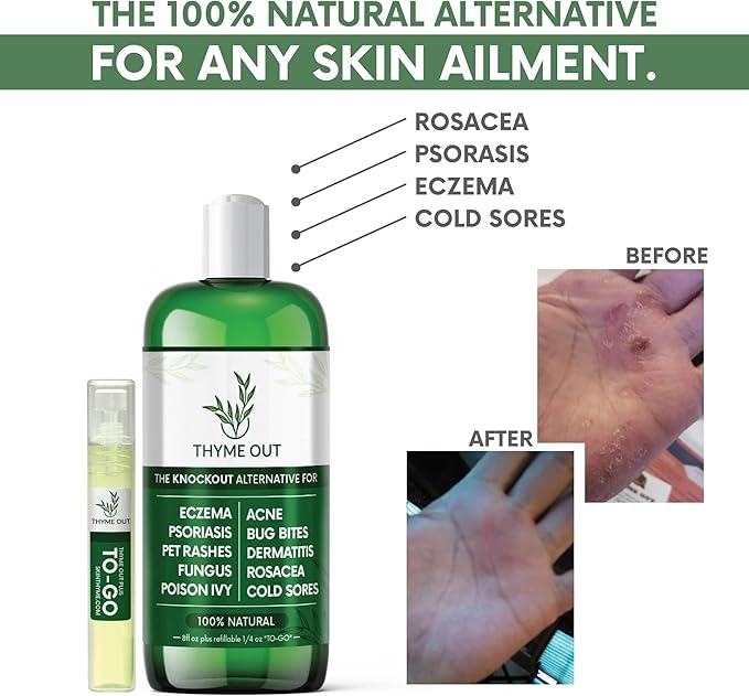 All Natural Eczema Treatment- Psoriasis Treatment - an All-in-One Solution for Acne, Dermatitis, Rosacea, Cold Sores, Pet Rashes, Bug Bites, and Poison Ivy - Anti-Itch Spray for Itchy Skin Relief
