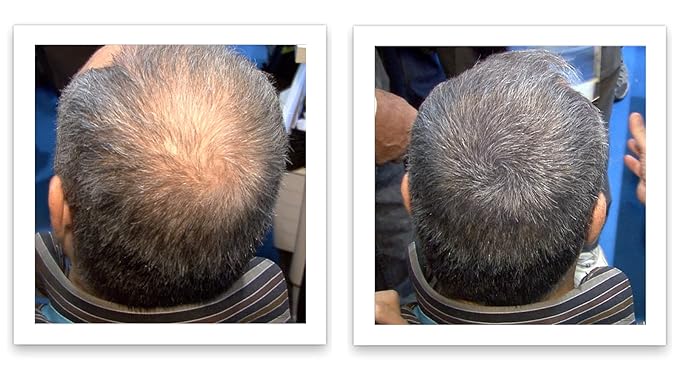 Hair Fibers For Hair Loss. Cover Bald Spot and Thinning Hair Instantly. Make Thin Hair Look 10X Fuller. All-Natural Hair Building Fiber. Trial Size (10-Day Supply). Dark Gray