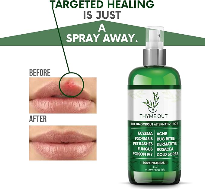 All Natural Eczema Treatment- Psoriasis Treatment - an All-in-One Solution for Acne, Dermatitis, Rosacea, Cold Sores, Bites, Poison Ivy - Anti-Itch Spray for Itchy Skin Relief 4oz