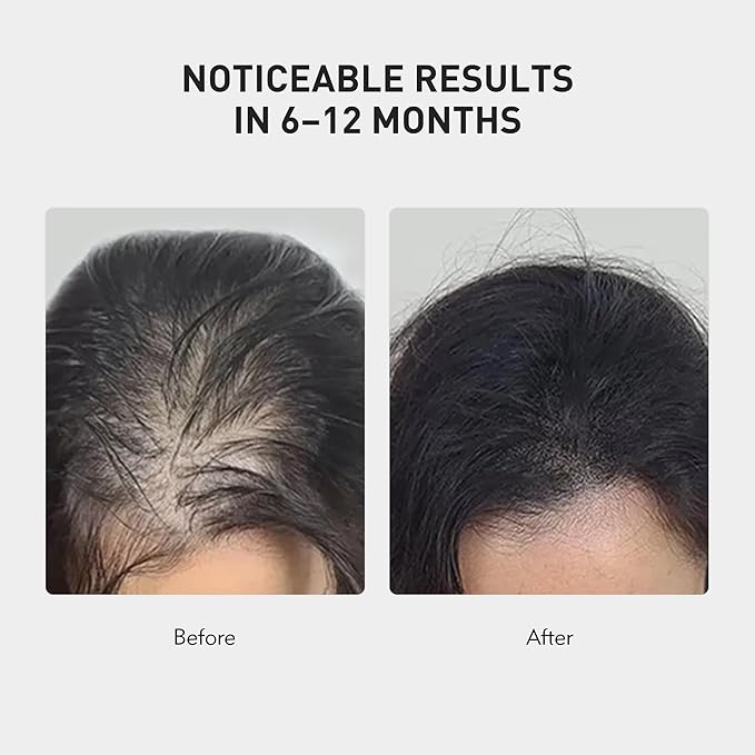 KINTOR 0.9% KX-826 Hair Regrowth Spray,Supporting Healthy Hair Growth,Oil Control, Hair Growth Products Group for Men&Women,Pro,60ml