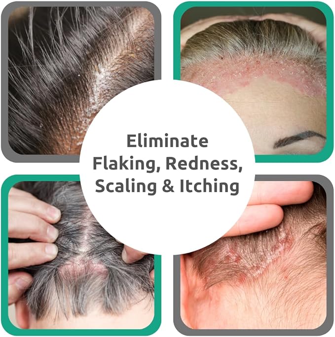 Dr. Blaine's Scalp Psoriasis Serum, Eliminate Itching, Scaling, Flaking, Redness - Fragrance-Free, Paraben-Free - Sal Acid & Allantoin - Travel Size 2 oz.