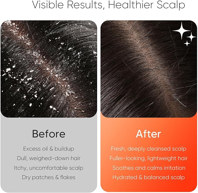 EKZ Sonic Vibrating Scalp Massager Shampoo Brush: Electric Silicone Hair Scrubber for Deep Scalp Clean, Dandruff Removal, Exfoliation, Stress Relief & Hair Growth –Suitable for Women, Men, Kids & Pets