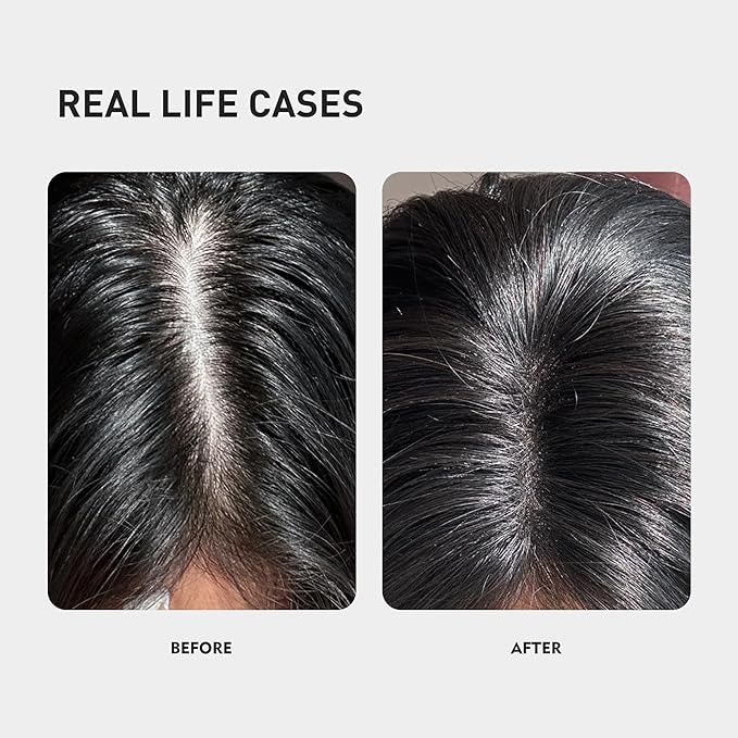 0.9% KX-826 KINTOR Hair Growth Spray,Strengthen Hair Nourish Hair follicles,Hair Care Products for Sparse Hair and Oily Hair Men&Women,360ml,Pro