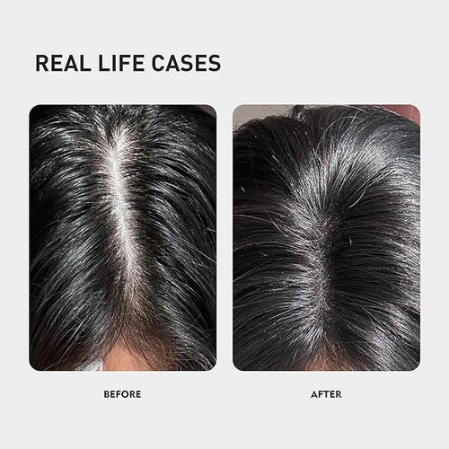 0.9% KX-826 KINTOR Hair Growth Spray,Strengthen Hair Nourish Hair follicles,Hair Care Products for Sparse Hair and Oily Hair Men&Women,360ml,Pro