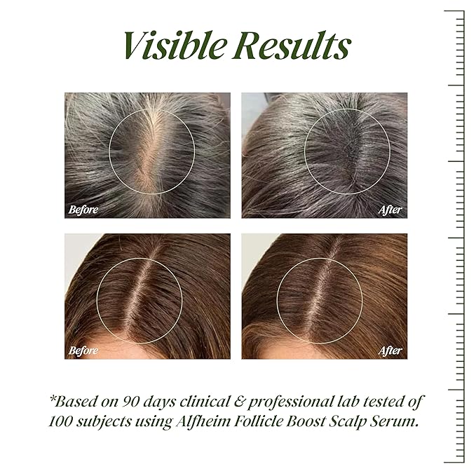 ALFHEIM Saw Palmetto Scalp Serum for Boost Follicle - Infused With Caffeine, Biotin for Thicker Hair - Balance Scalp, Rejuvenate Hair Follicles ＆ Improve Hair Density - 1.69 fl oz + Serum Applicator